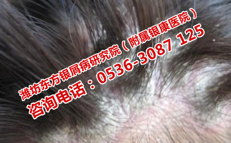 头部一丁点牛皮癣扩散