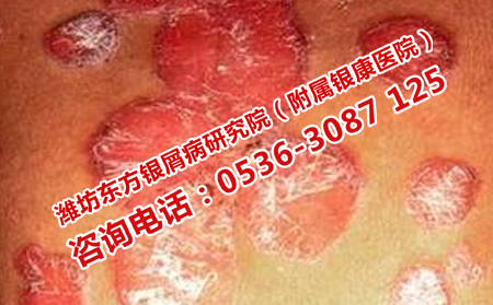 怎么改善牛皮癣危害