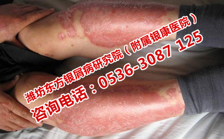 腿部牛皮癣蔓延原因