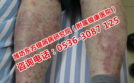 牛皮癣为什么会再次出现