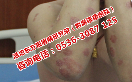 男性牛皮癣治疗