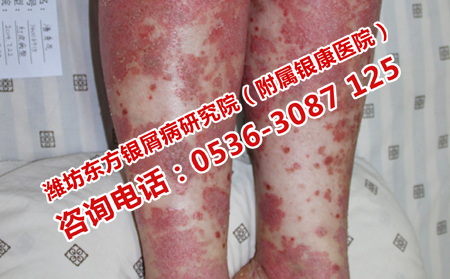 在哪治牛皮癣短期内治可以