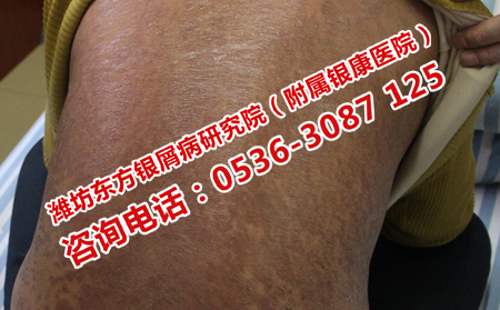后背牛皮癣怎么消除