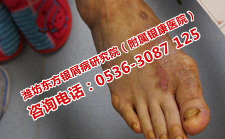 四肢牛皮癣发展严重