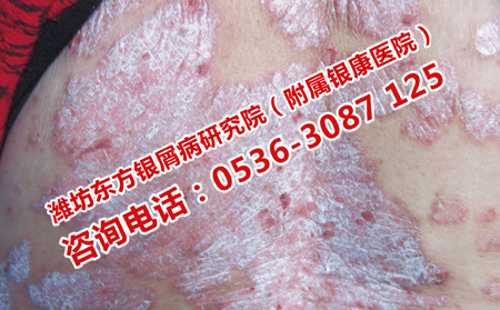 背部出现牛皮癣怎么消除