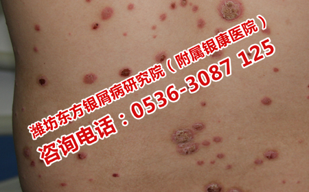 得了牛皮癣怎么恢复健康