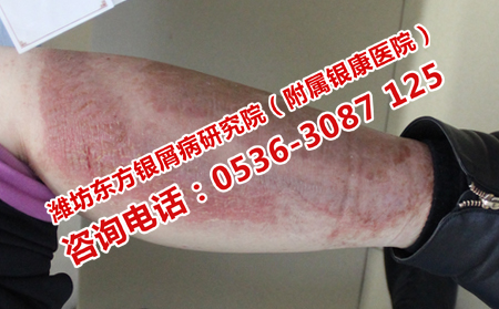 牛皮癣怎么治疗减少病情发展
