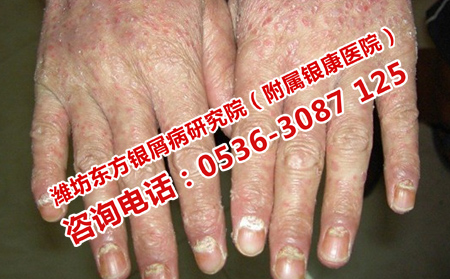 手背牛皮癣发展怎么回事