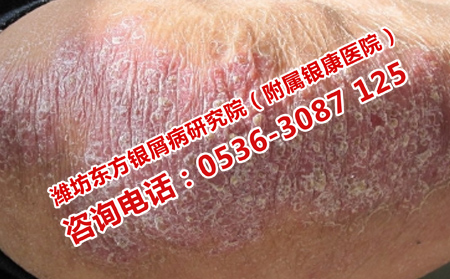 济南牛皮癣医院治疗费