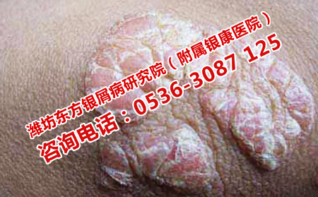 治疗牛皮癣的软膏