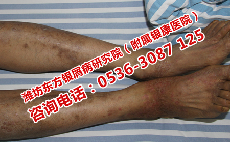 治疗银屑病什么方法可以