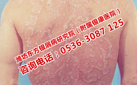 后天发生银屑病的原因