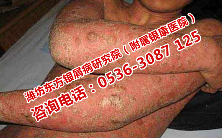 济南银屑病医院贵吗