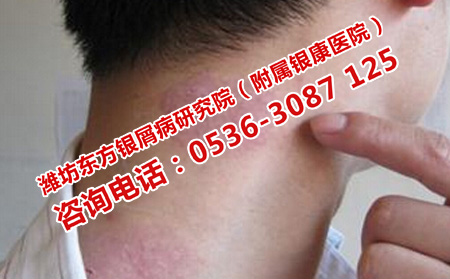 去哪里治多年银屑病