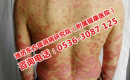 成年人银屑病如何治疗