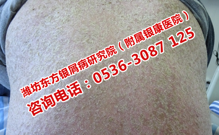 天桥区靠谱的银屑病医院