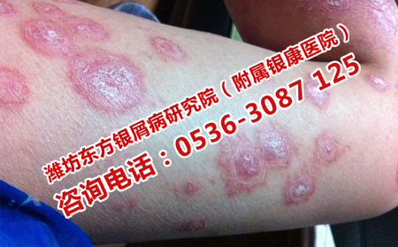 寻常性银屑病恶化的原因