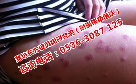 济南银屑病医院医疗正规吗
