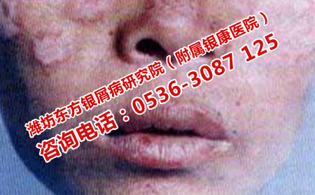 如何减少女性银屑病复发