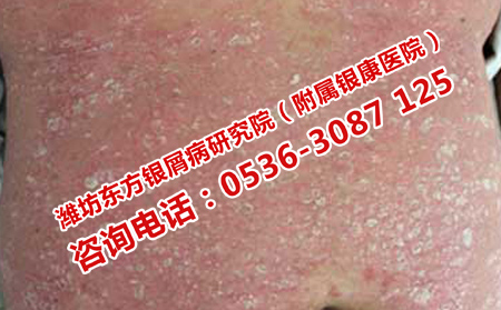 银屑病瘙痒症状如何消除
