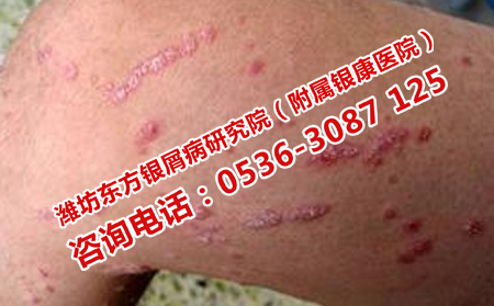 选择济南哪家医院治银屑病