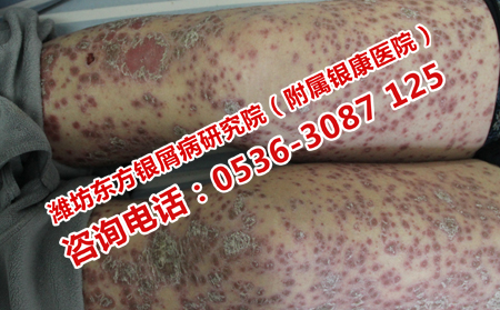 掌跖脓疱病的治疗时间