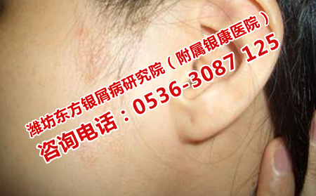 银屑病治疗期间的护理