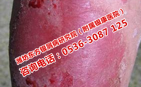 银屑病治疗的误区
