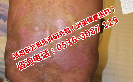 长清银屑病治疗