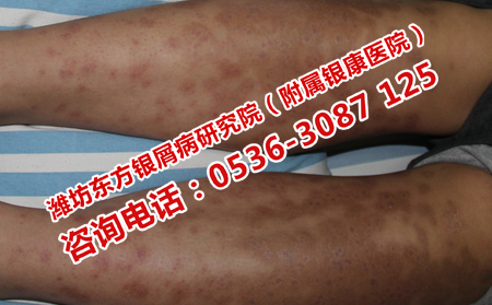 银屑病治疗费用是