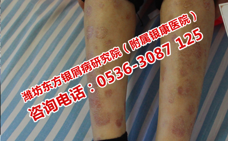 银屑病复发之前的症状