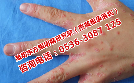 过年期间预防银屑病反复