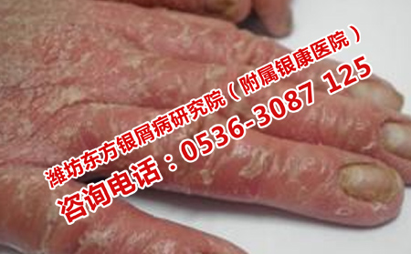 为何银屑病要预防复发