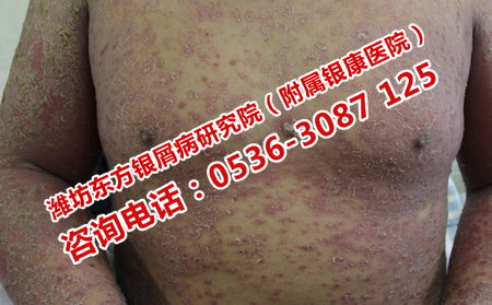 过年期间去哪里治银屑病