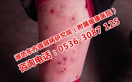 四肢银屑病的治疗办法