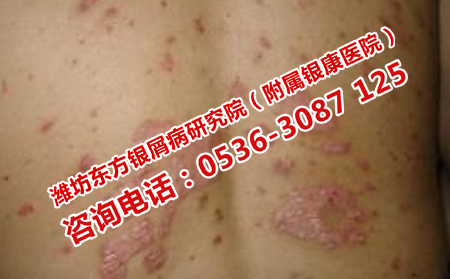 护理背部银屑病的办法