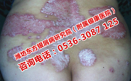 章丘有名的银屑病医院