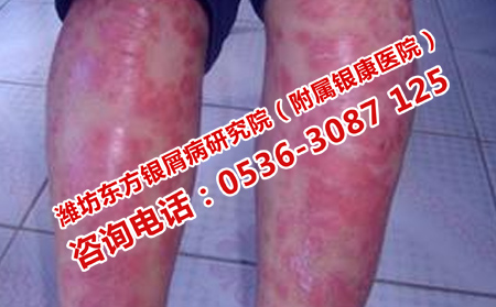 银屑病与咽炎的关系