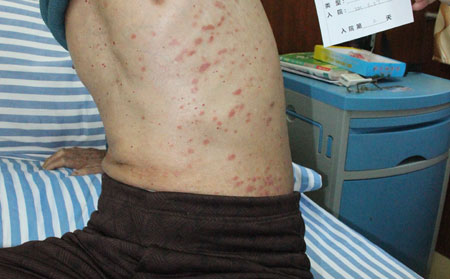 济南银屑病医院治疗如何
