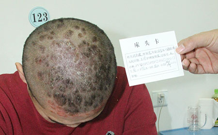 得了银屑病吃那些药