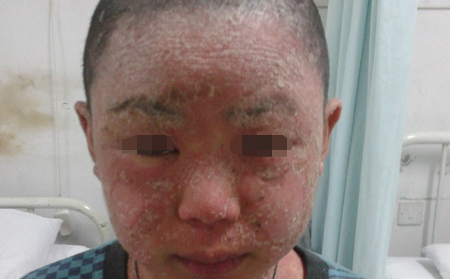 头部银屑病患者如何洗头