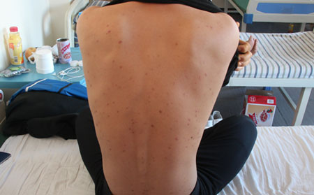 牛皮癣治疗中的危害