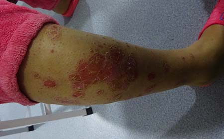 中医治银屑病介绍