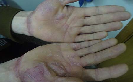 银屑病治疗方法